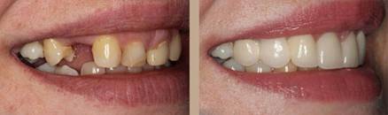 hypodontia before and after